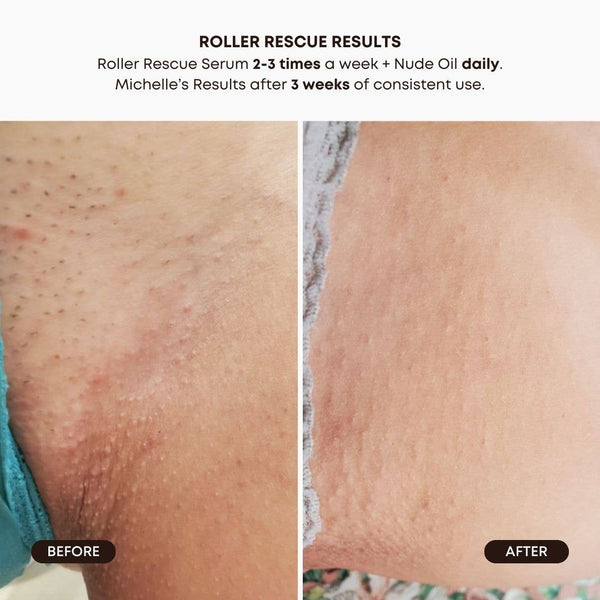 Roller Rescue Ingrown Hair Soothing Serum